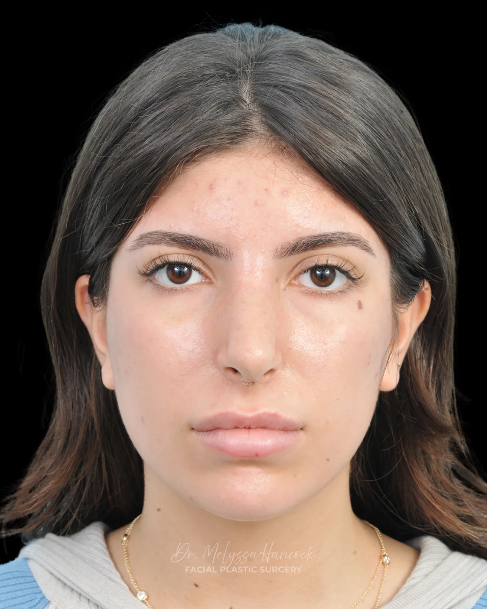 Photo of the patient’s after the Rhinoplasty Patient 35