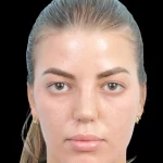 Thumbnail photo of the patient’s after the Rhinoplasty Patient 36