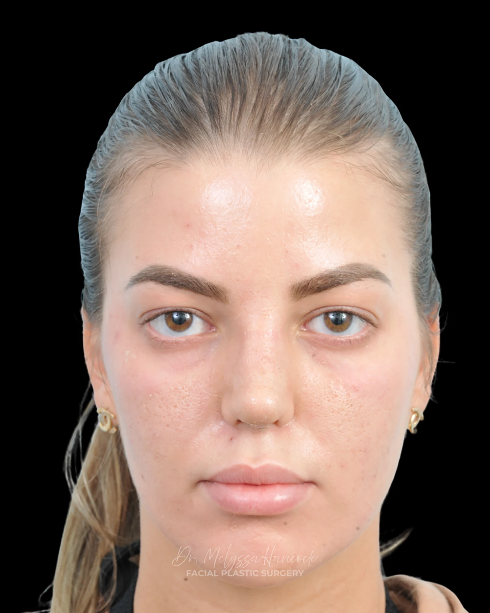 Photo of the patient’s after the Rhinoplasty Patient 36