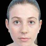 Thumbnail photo of the patient’s after the Rhinoplasty Patient 37