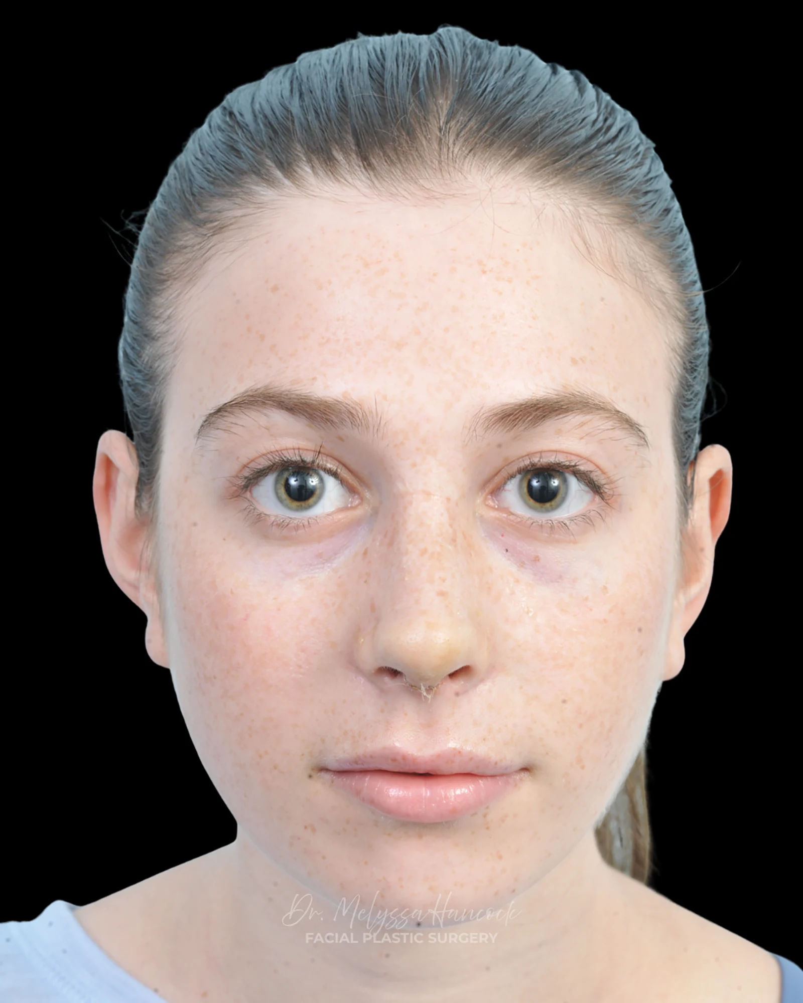 Photo of the patient’s after the Rhinoplasty Patient 37