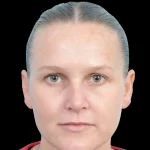 Thumbnail photo of the patient’s after the Rhinoplasty Patient 38