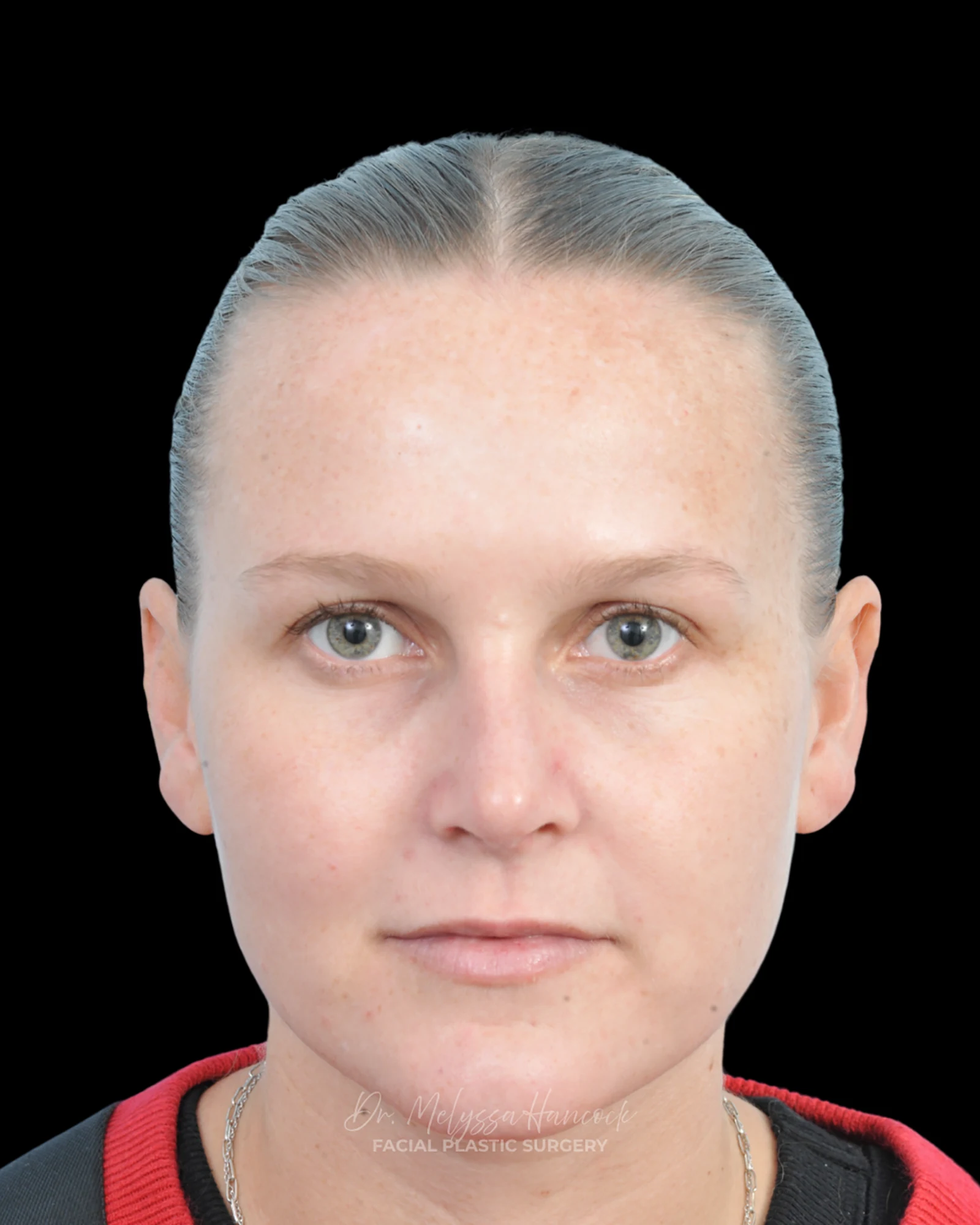 Photo of the patient’s after the Rhinoplasty Patient 38