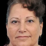 Thumbnail photo of the patient’s after the Rhinoplasty Patient 40