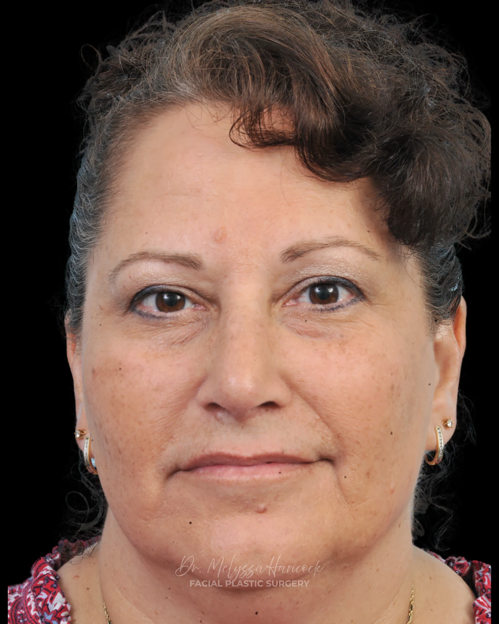Photo of the patient’s after the Rhinoplasty Patient 40