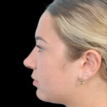 Thumbnail photo of the patient’s after the Rhinoplasty Patient 15