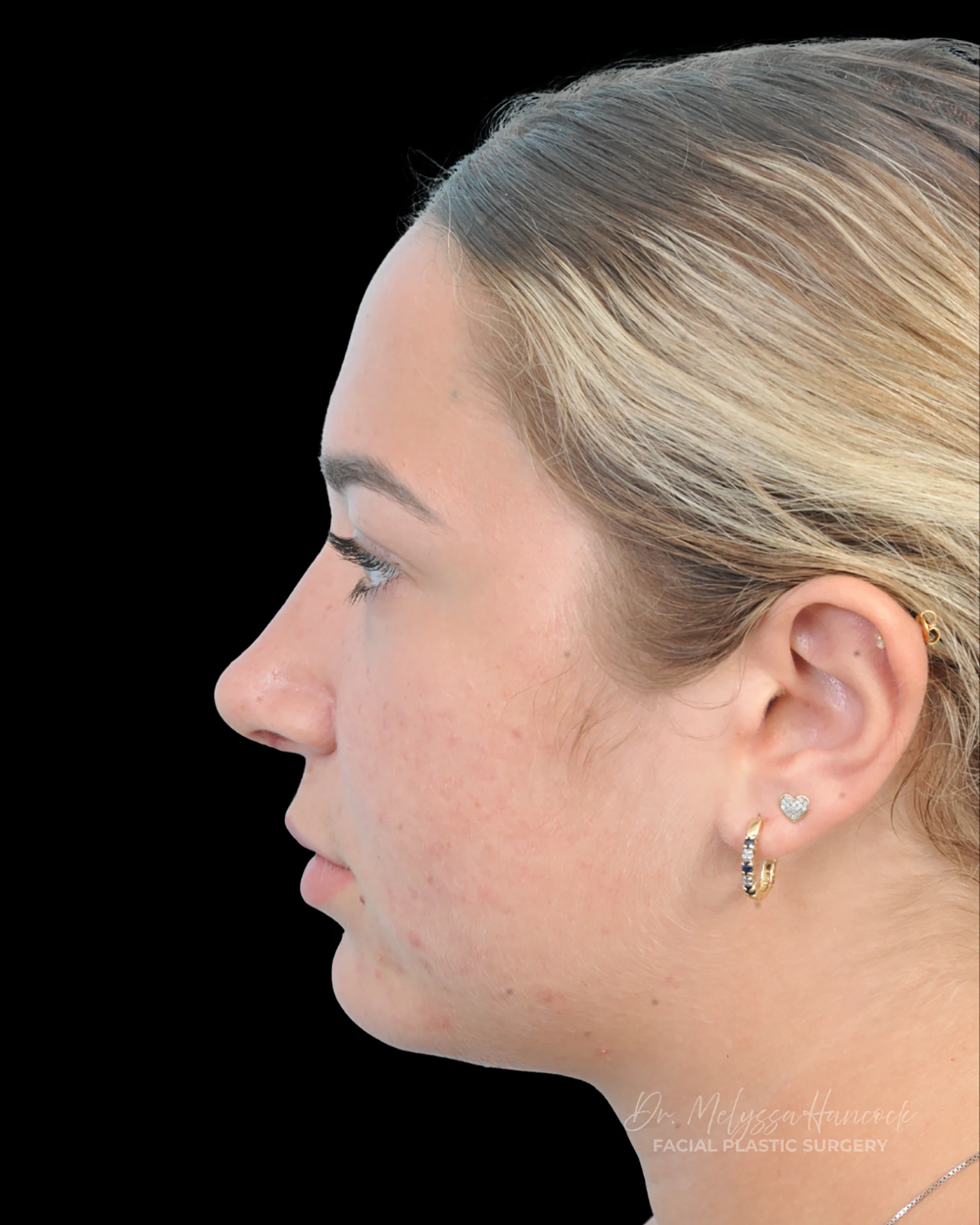 Photo of the patient’s after the Rhinoplasty Patient 15