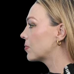 Thumbnail photo of the patient’s after the Rhinoplasty Patient 20