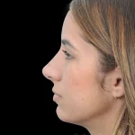 Thumbnail photo of the patient’s after the Rhinoplasty Patient 26