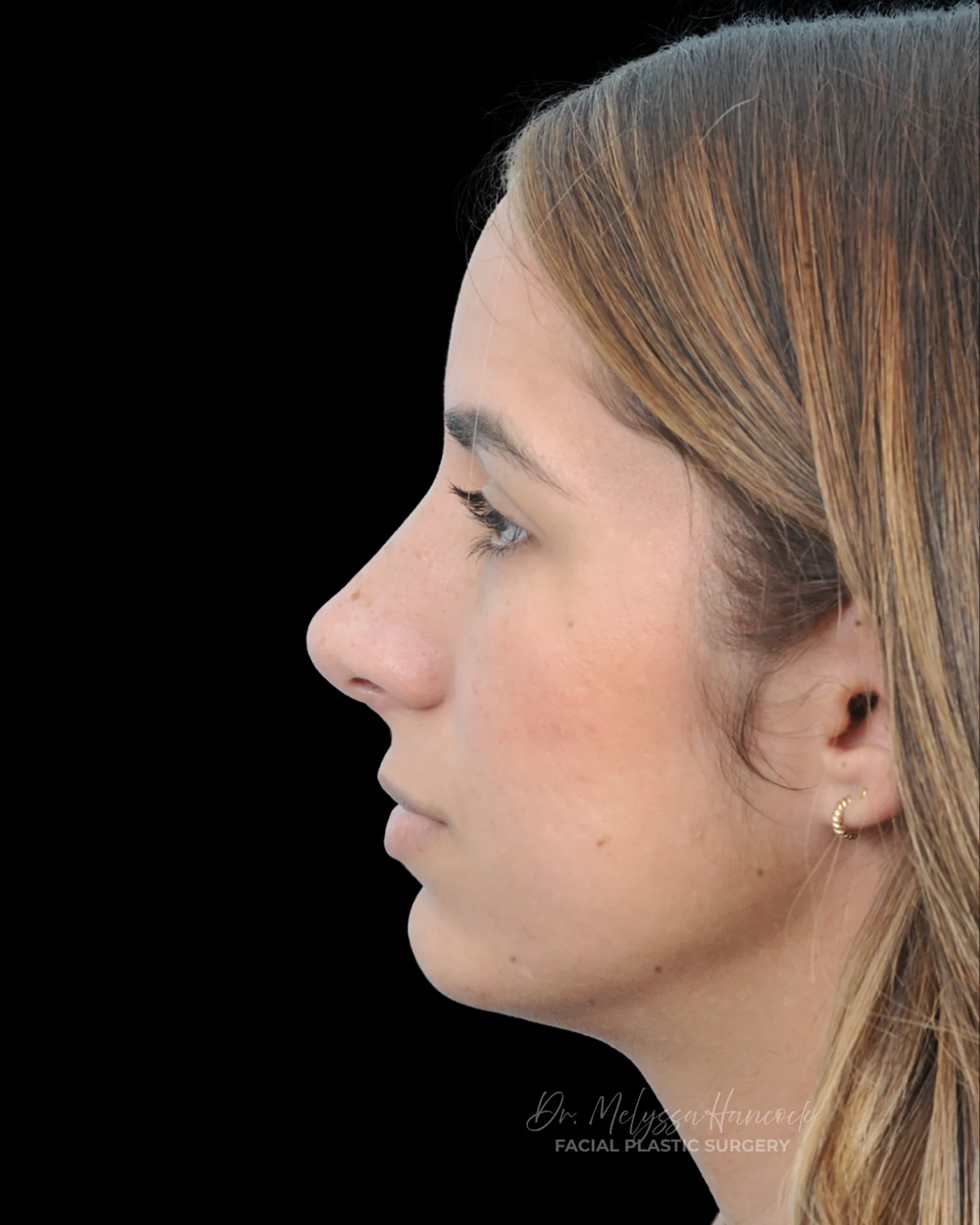 Photo of the patient’s after the Rhinoplasty Patient 26