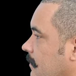 Thumbnail photo of the patient’s after the Rhinoplasty Patient 27