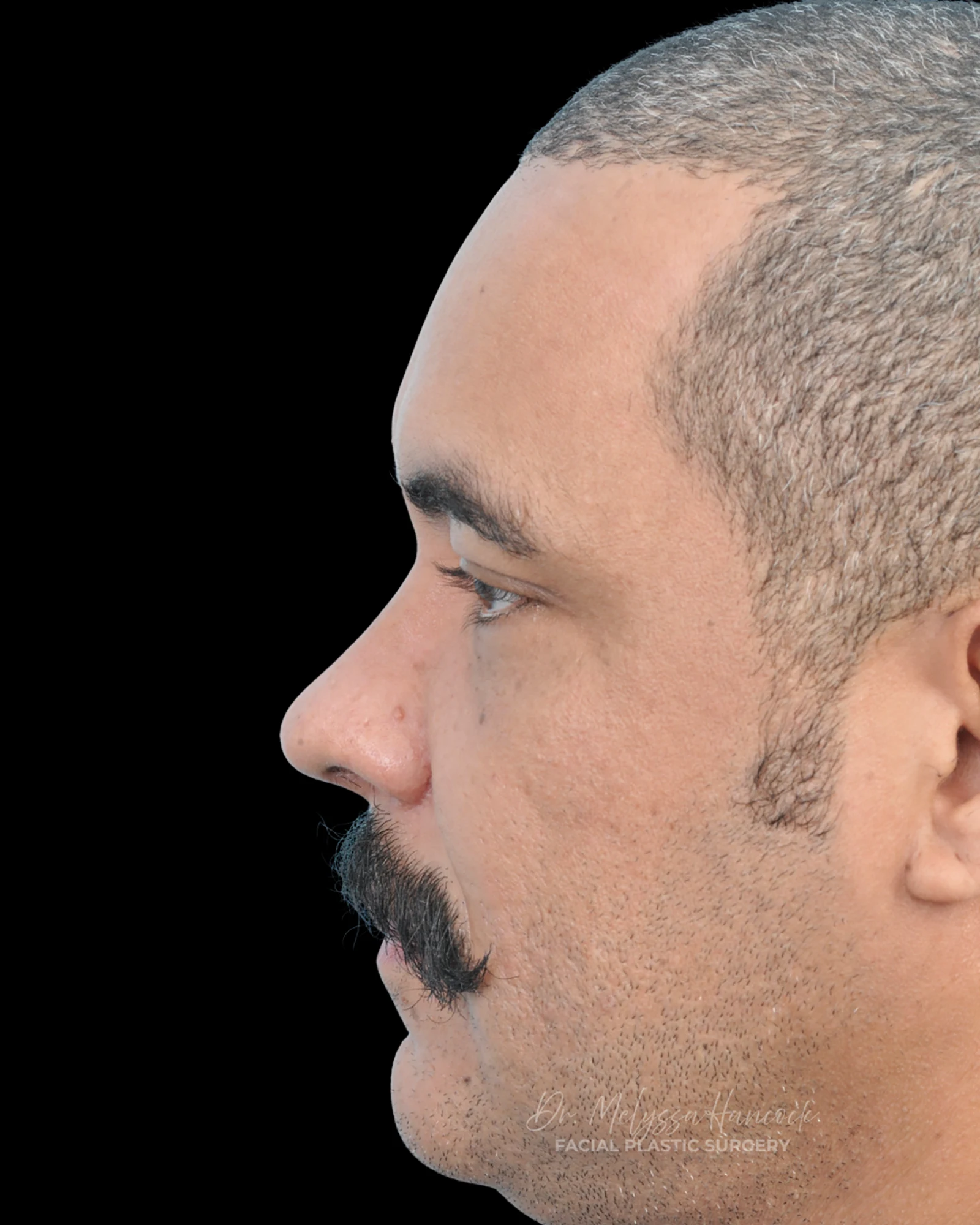 Photo of the patient’s after the Rhinoplasty Patient 27