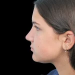 Thumbnail photo of the patient’s after the Rhinoplasty Patient 28