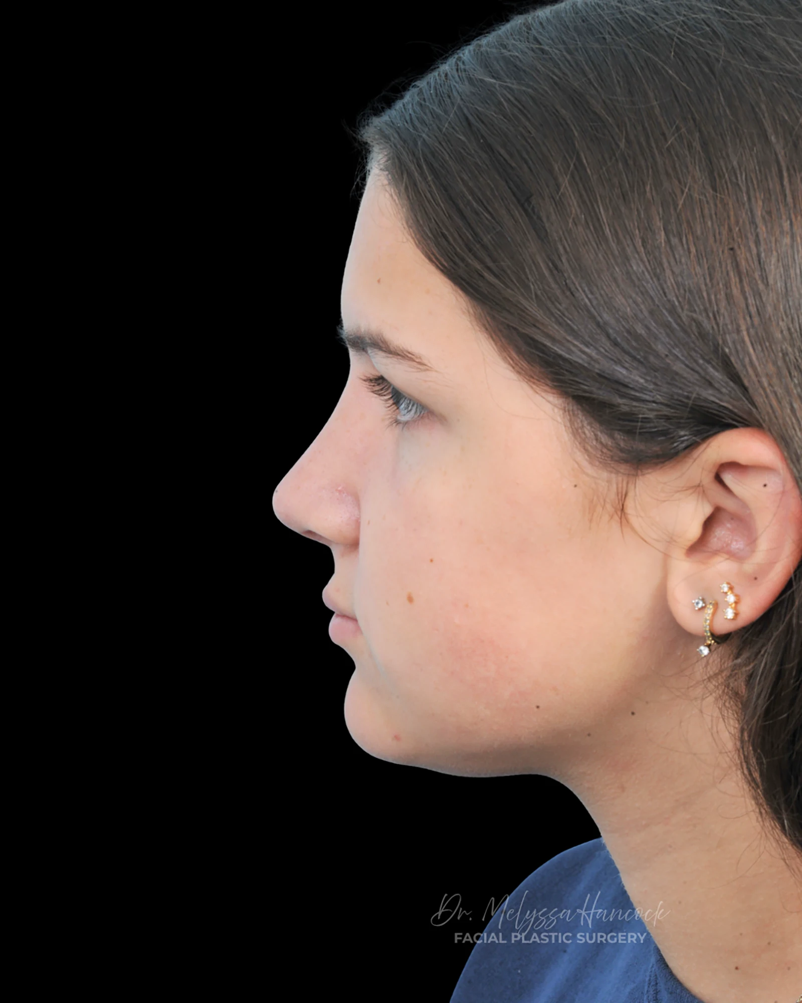 Photo of the patient’s after the Rhinoplasty Patient 28