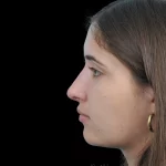 Thumbnail photo of the patient’s after the Rhinoplasty Patient 29