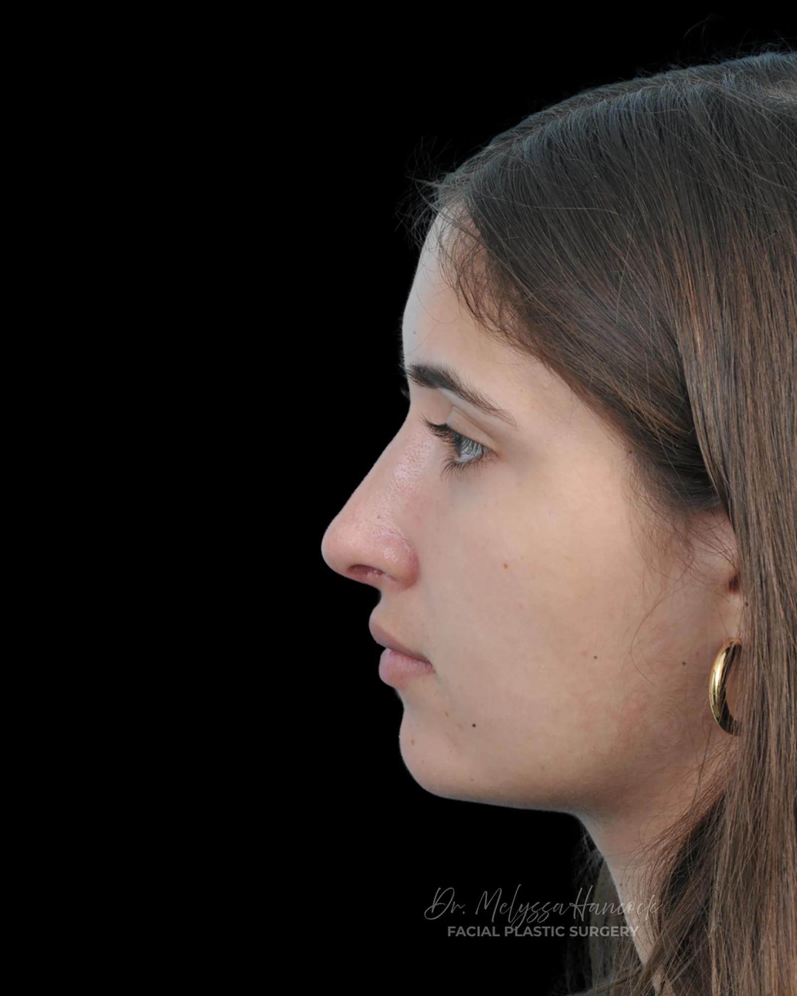 Photo of the patient’s after the Rhinoplasty Patient 29