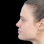 Thumbnail photo of the patient’s after the Rhinoplasty Patient 30