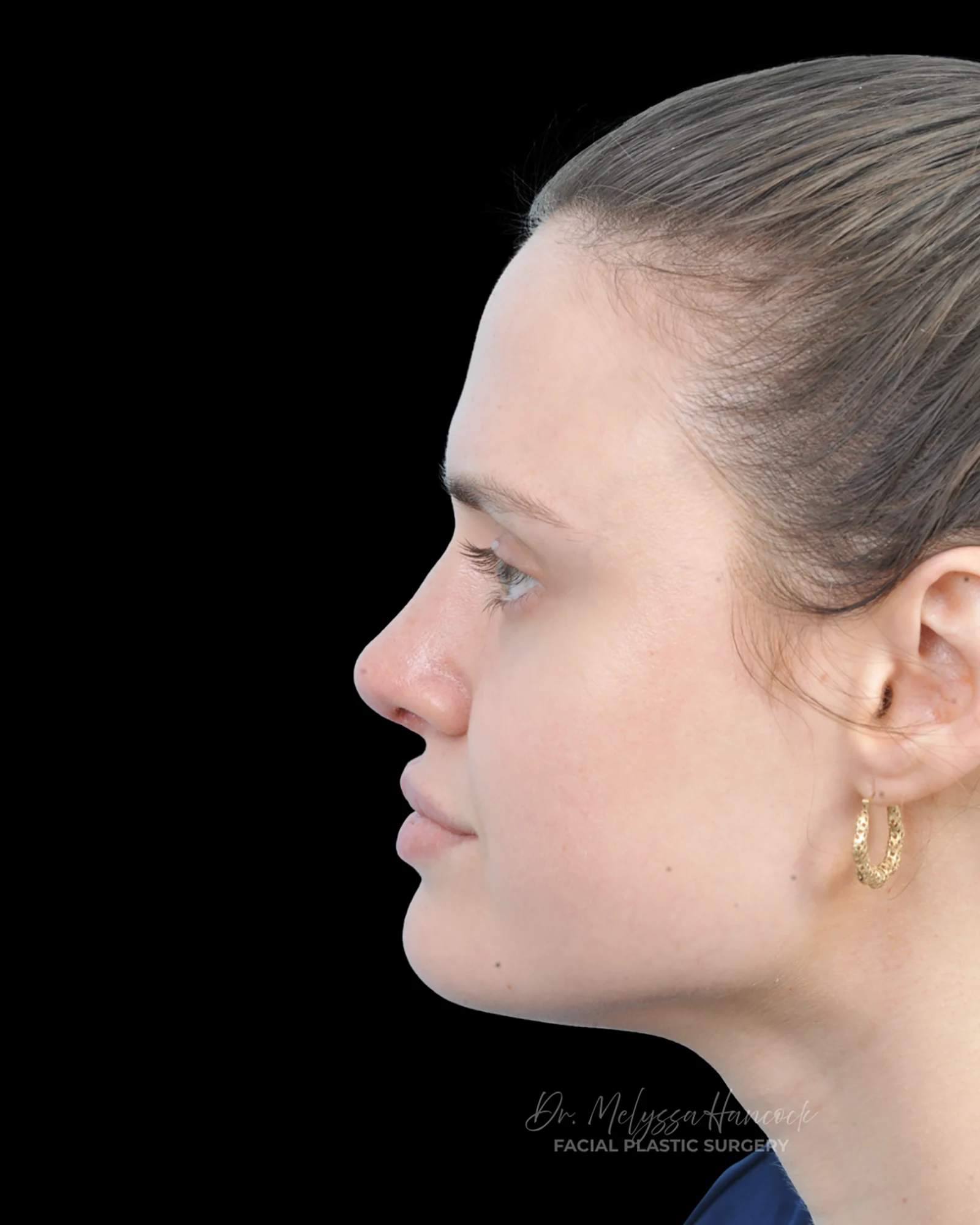 Photo of the patient’s after the Rhinoplasty Patient 30