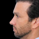 Thumbnail photo of the patient’s after the Rhinoplasty Patient 31