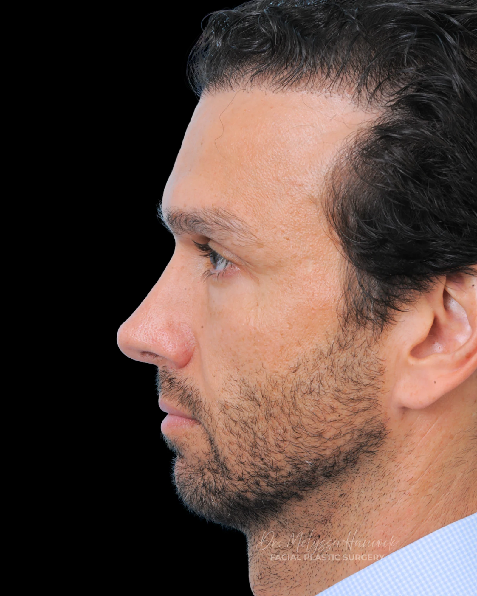 Photo of the patient’s after the Rhinoplasty Patient 31