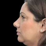 Thumbnail photo of the patient’s after the Rhinoplasty Patient 32