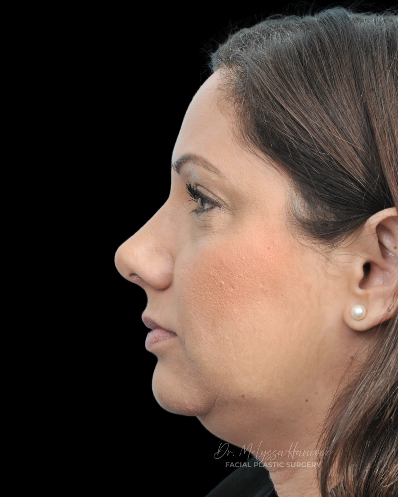 Photo of the patient’s after the Rhinoplasty Patient 32