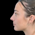 Thumbnail photo of the patient’s after the Rhinoplasty Patient 33