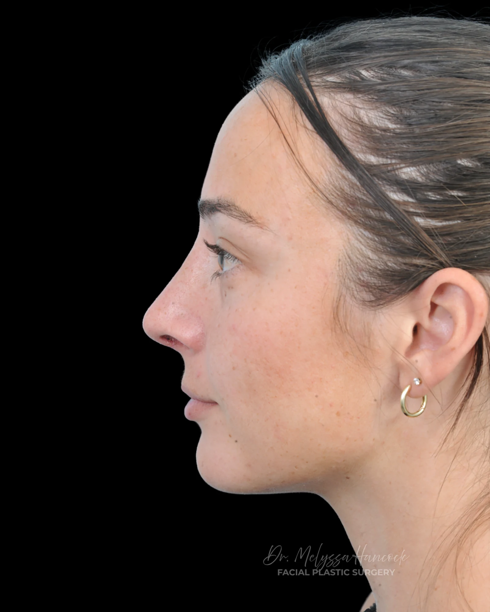 Photo of the patient’s after the Rhinoplasty Patient 33
