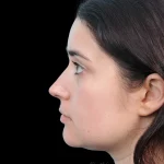 Thumbnail photo of the patient’s after the Rhinoplasty Patient 34