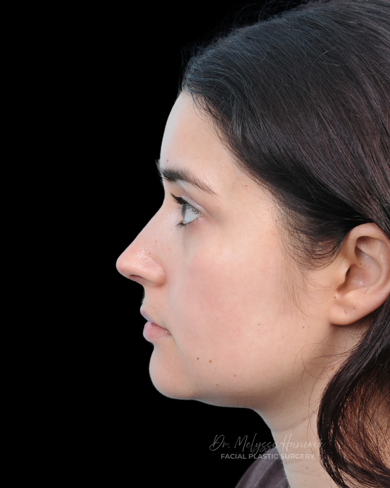 Photo of the patient’s after the Rhinoplasty Patient 34