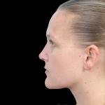 Thumbnail photo of the patient’s after the Rhinoplasty Patient 38
