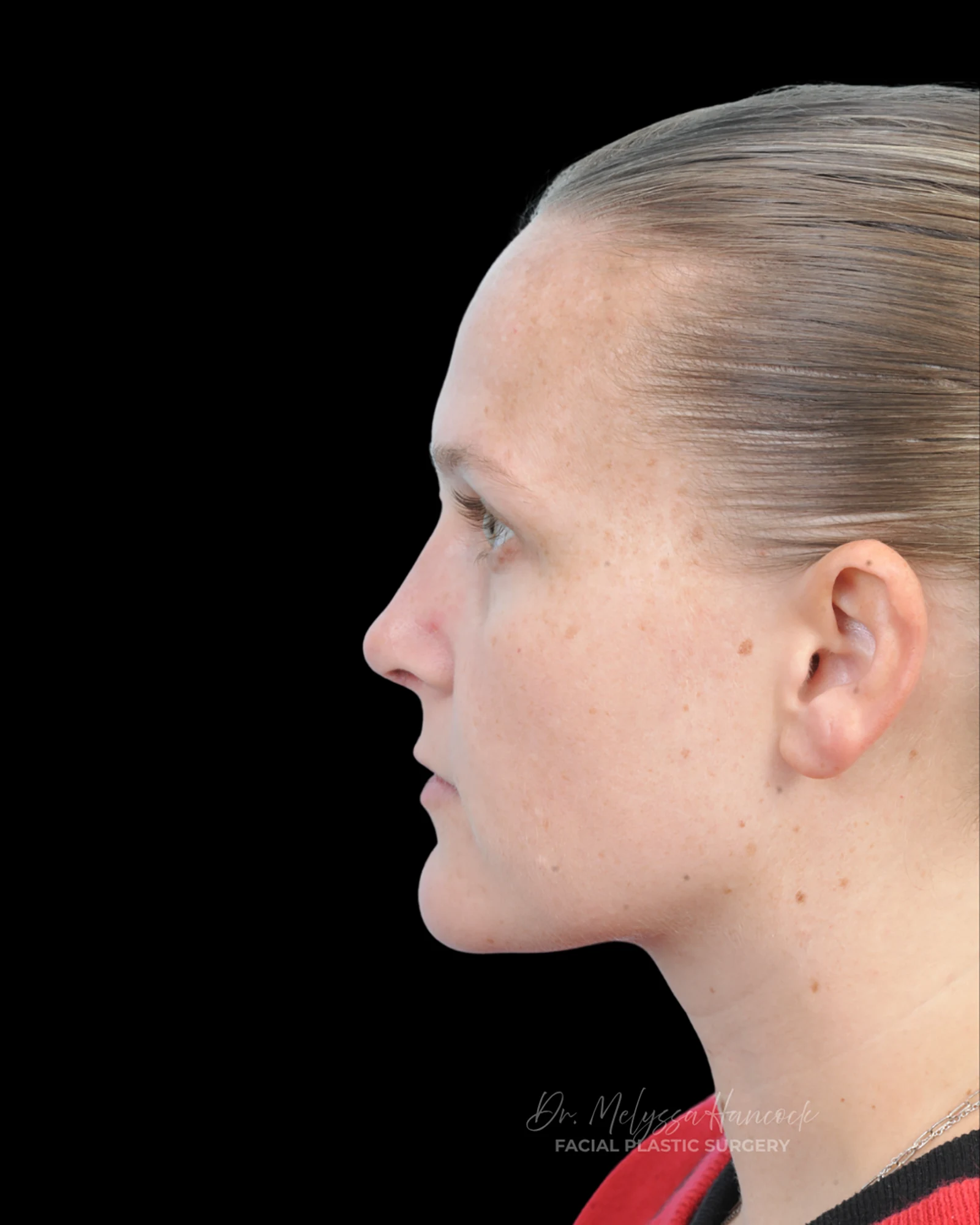 Photo of the patient’s after the Rhinoplasty Patient 38