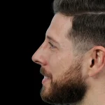 Thumbnail photo of the patient’s after the Rhinoplasty Patient 39