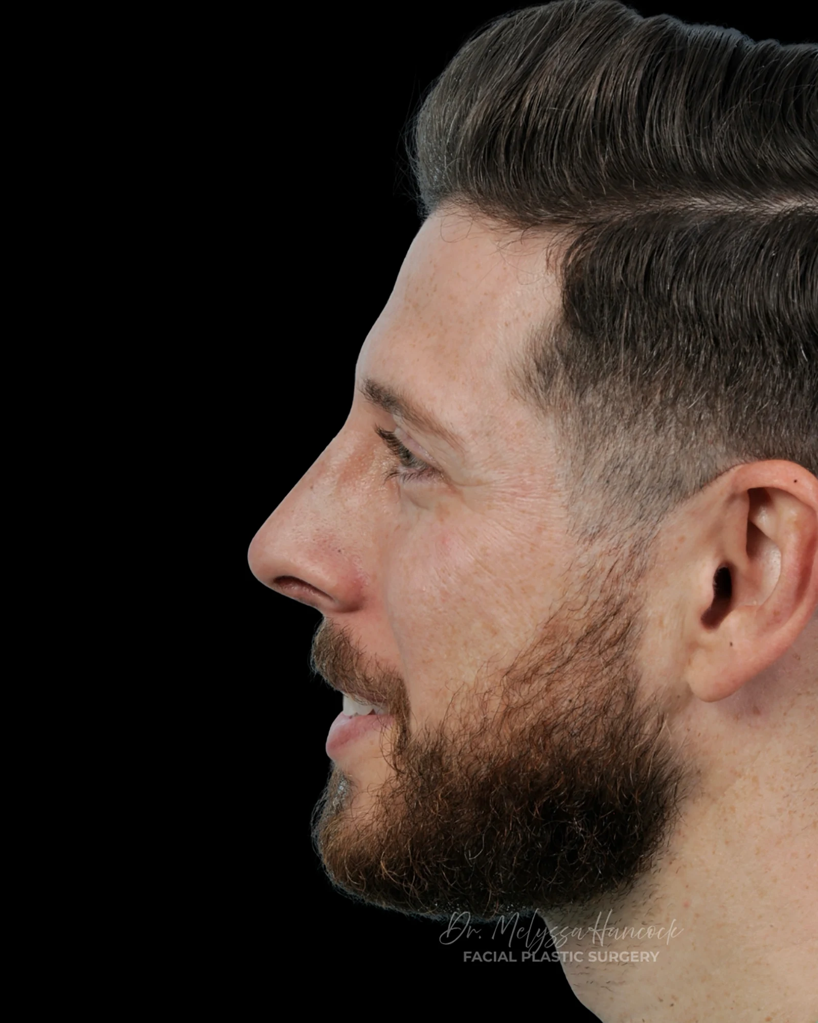 Photo of the patient’s after the Rhinoplasty Patient 39