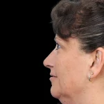 Thumbnail photo of the patient’s after the Rhinoplasty Patient 40