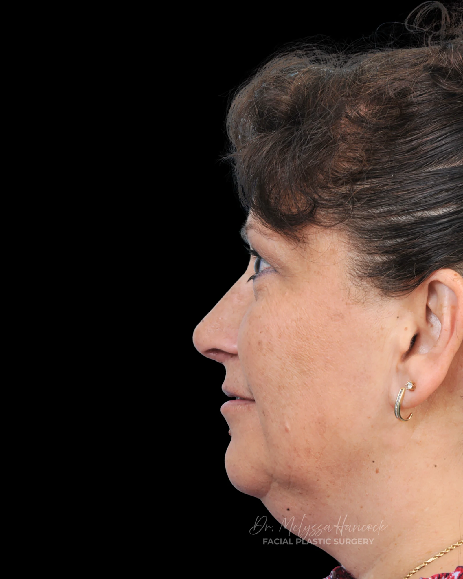 Photo of the patient’s after the Rhinoplasty Patient 40