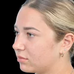 Thumbnail photo of the patient’s after the Rhinoplasty Patient 15