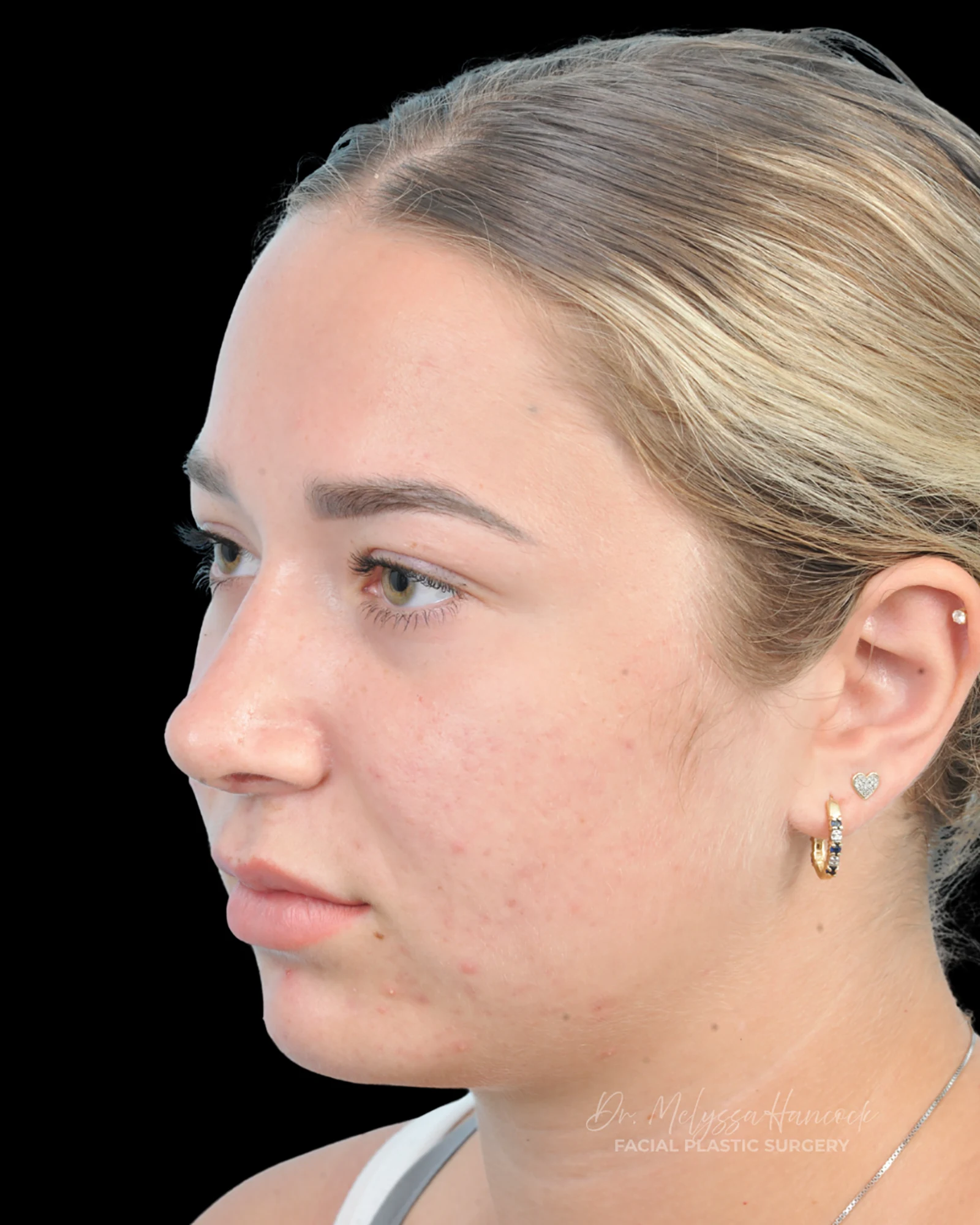 Photo of the patient’s after the Rhinoplasty Patient 15