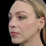 Thumbnail photo of the patient’s after the Rhinoplasty Patient 20