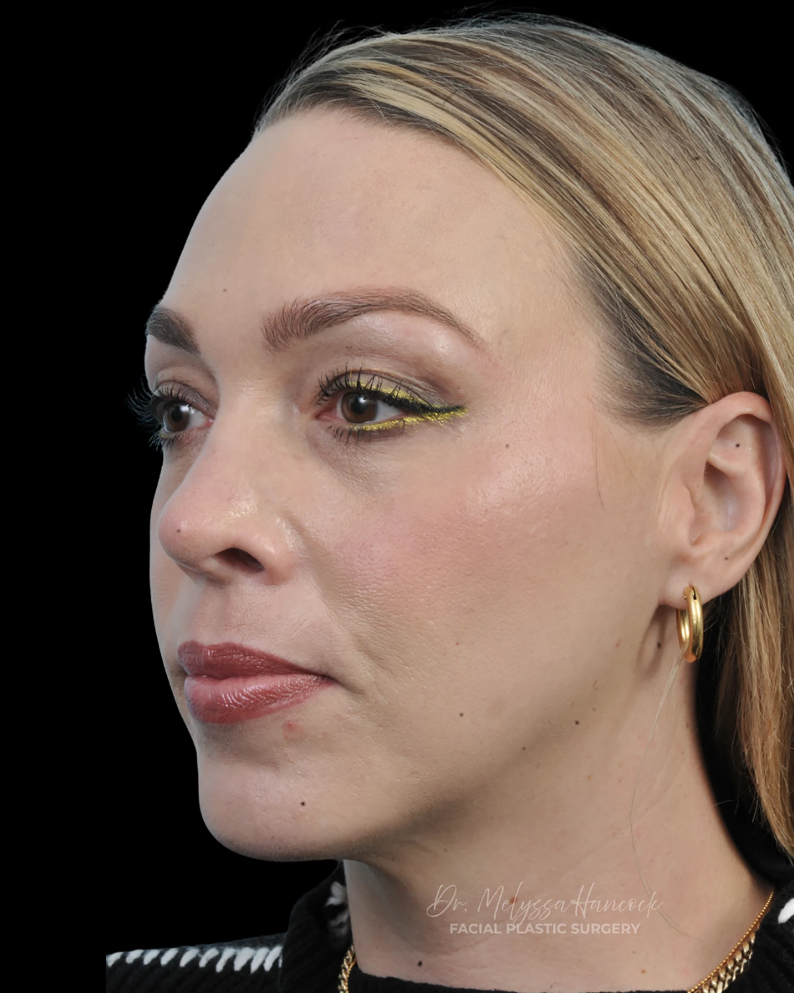 Photo of the patient’s after the Rhinoplasty Patient 20