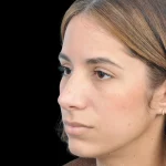 Thumbnail photo of the patient’s after the Rhinoplasty Patient 26