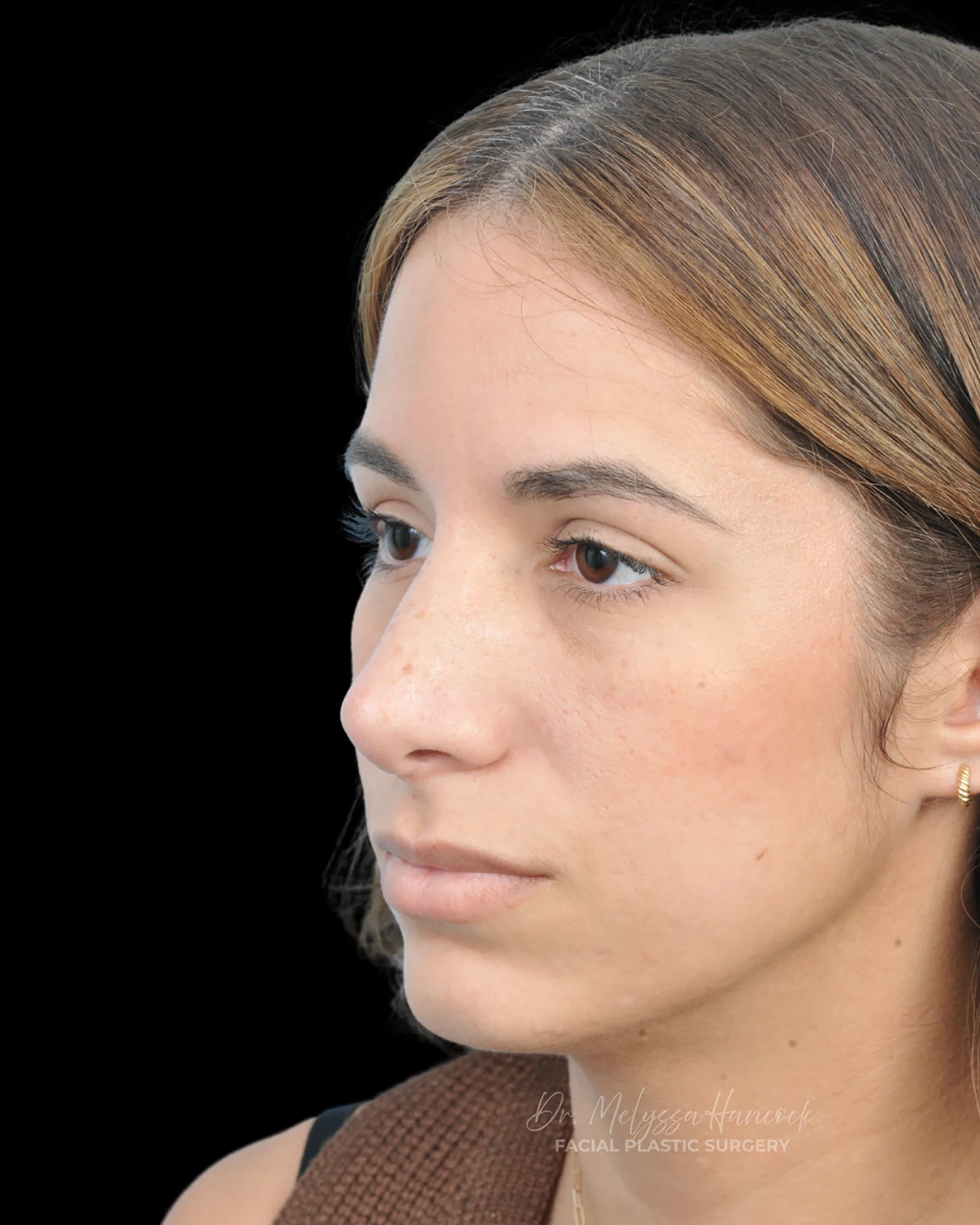 Photo of the patient’s after the Rhinoplasty Patient 26
