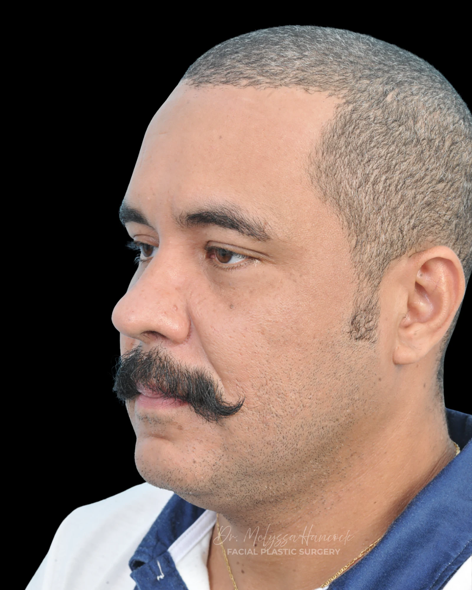 Photo of the patient’s after the Rhinoplasty Patient 27