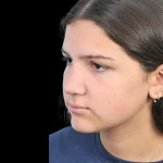 Thumbnail photo of the patient’s after the Rhinoplasty Patient 28