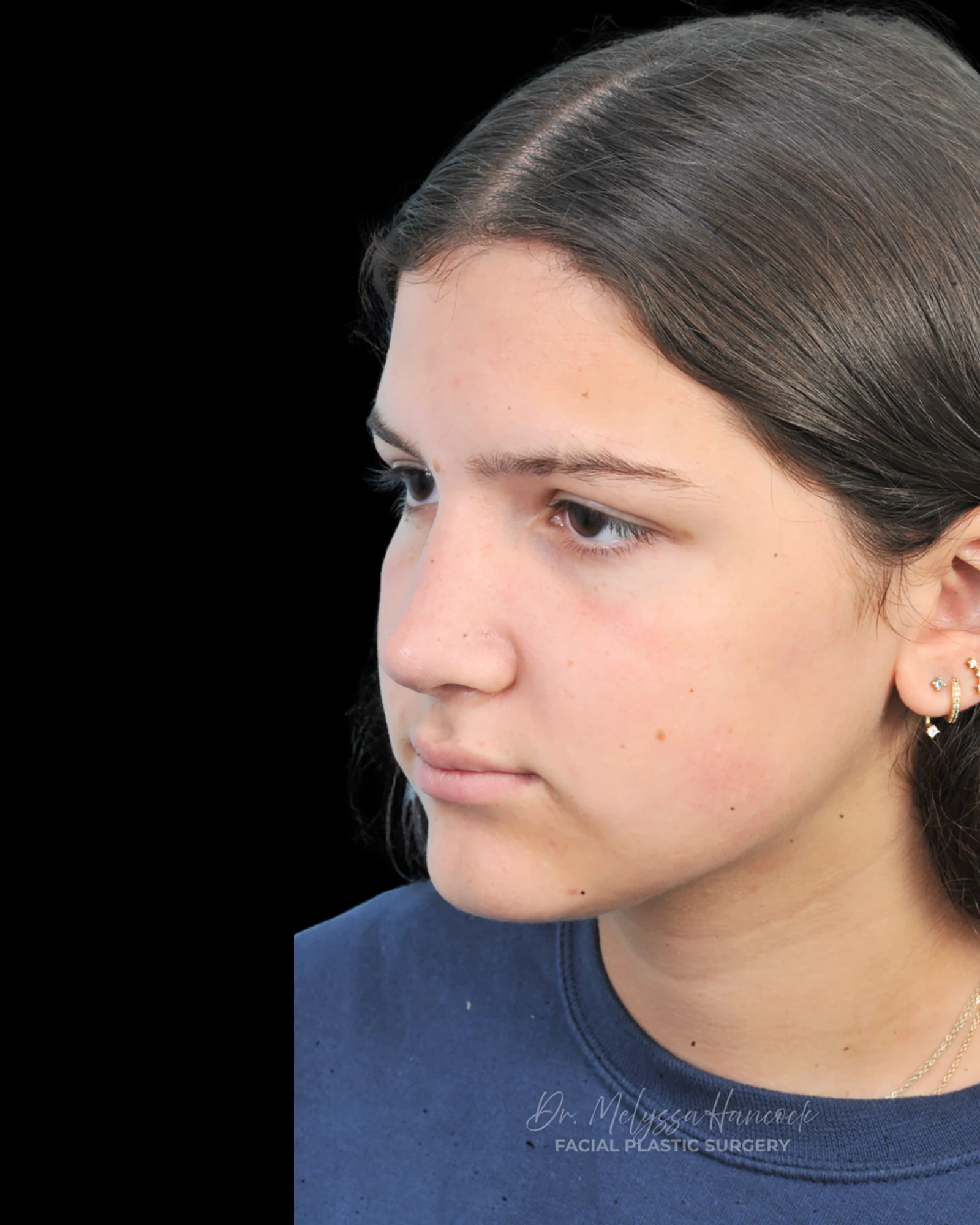 Photo of the patient’s after the Rhinoplasty Patient 28