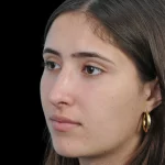 Thumbnail photo of the patient’s after the Rhinoplasty Patient 29
