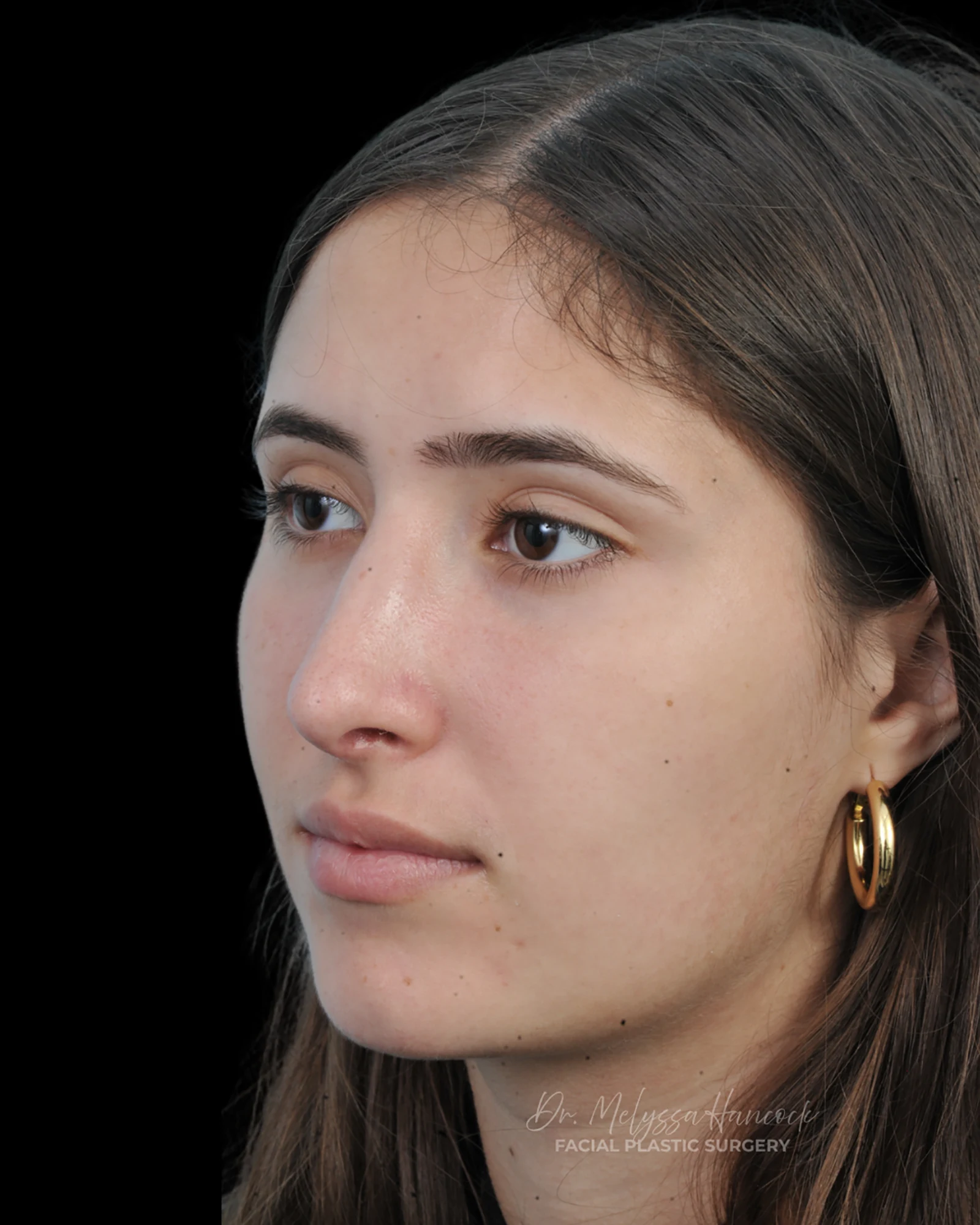 Photo of the patient’s after the Rhinoplasty Patient 29