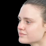 Thumbnail photo of the patient’s after the Rhinoplasty Patient 30