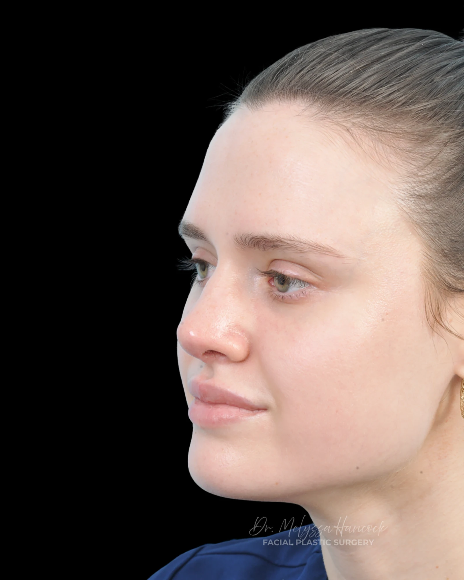 Photo of the patient’s after the Rhinoplasty Patient 30