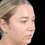 Thumbnail photo of the patient’s after the Rhinoplasty Patient 15